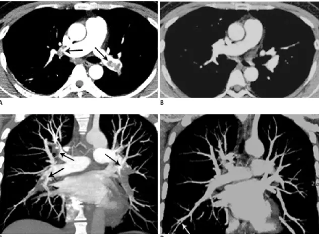 Fig. 1. Computed tomography pulmonary angigraphy images before and after thrombolytic and anticoagulation therapy (A-D), and  detection of peripheral arterial thrombi at the right lower lung (E-H), and OCT images and pathological study of the thrombus (I-L