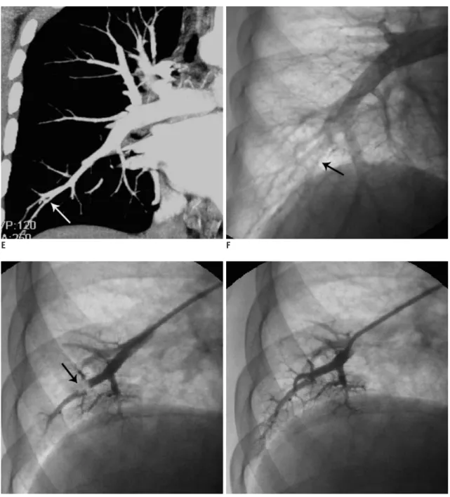 Fig. 1. Computed tomography pulmonary angigraphy images before and after thrombolytic and anticoagulation therapy (A-D), and  detection of peripheral arterial thrombi at the right lower lung (E-H), and OCT images and pathological study of the thrombus (I-L