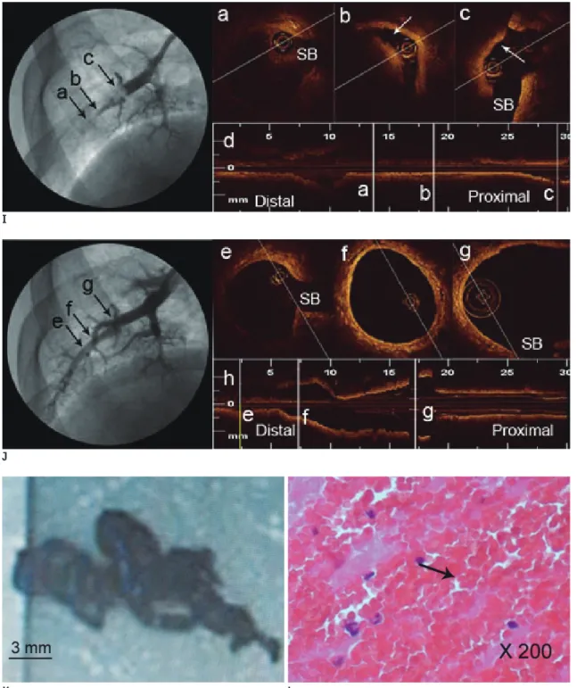 Fig. 1. Computed tomography pulmonary angigraphy images before and after thrombolytic and anticoagulation therapy (A-D), and  detection of peripheral arterial thrombi at the right lower lung (E-H), and OCT images and pathological study of the thrombus (I-L