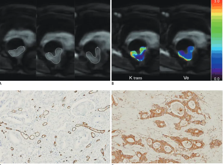 Fig. 1. Dynamic contrast-enhanced magnetic resonance imaging image of pathologically T2N0 rectal cancer from 50-year-old woman.