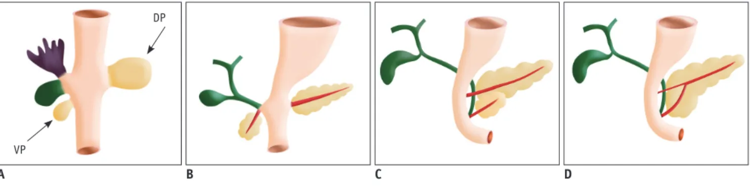 Fig. 1. Drawings show normal embrologic development of pancreas.