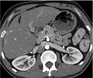 Fig. 13. Axial MDCT image shows pancreatic tissue (arrow)  extending in anterolateral direction to second part of  duodenum (D) and dilatation of stomach (St) in patient with  incomplete annular pancreas