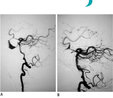 Fig. 1. Left vertebral artery angiograms.