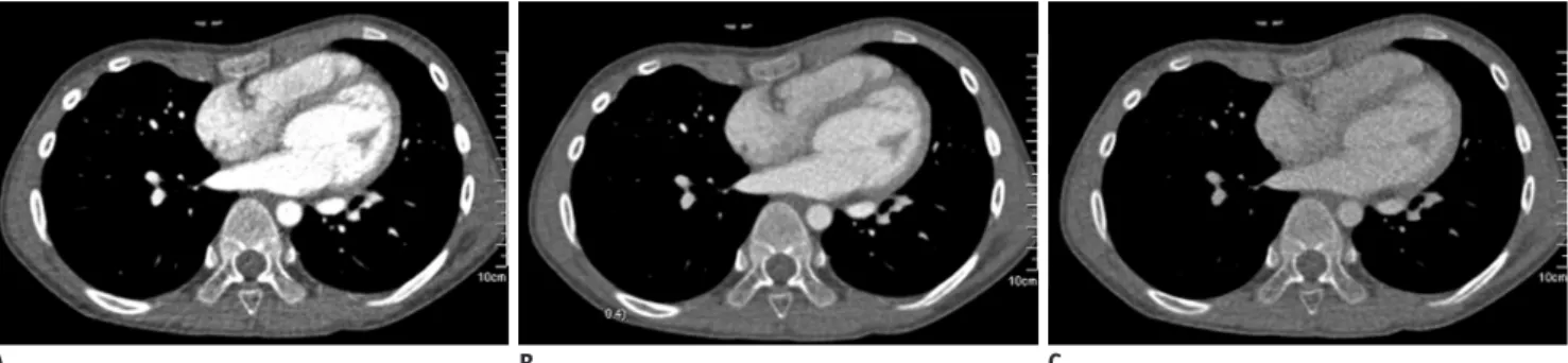 Fig. 1. Axial contrast-enhanced chest CT images using dual-source CT system with different energy levels  (A: 80 kVp, B: mixed with  composition ratio of 0.4, C: 140 kVp with tin filter)