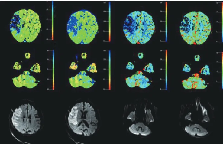 Fig. 4. Measurement of perfusion value and degree of  reduction of cerebral perfusion value in each CT perfusion  map