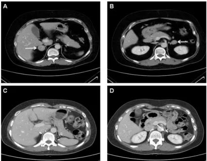 Table  1.  Adrenal  vein  sampling  data  were  consistent  with  hypercortisolism  from  both  adrenal  gland