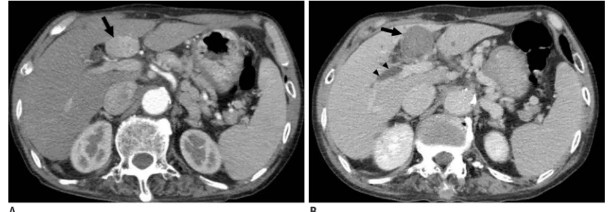 Table 4. Summary of Events: Technical Failures, Local Tumor Progression, and New Hepatocellular Carcinoma  Occurrence 