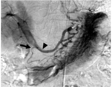Fig. 4. Termination patterns of aberrant right gastric vein. 