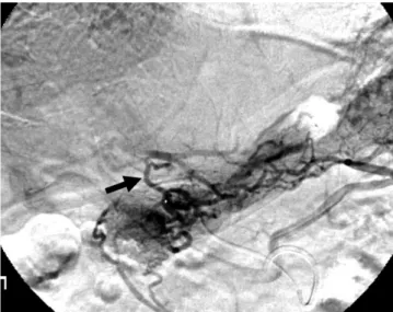 Fig. 5. Type I aberrant right gastric vein in 58-year-old woman.  