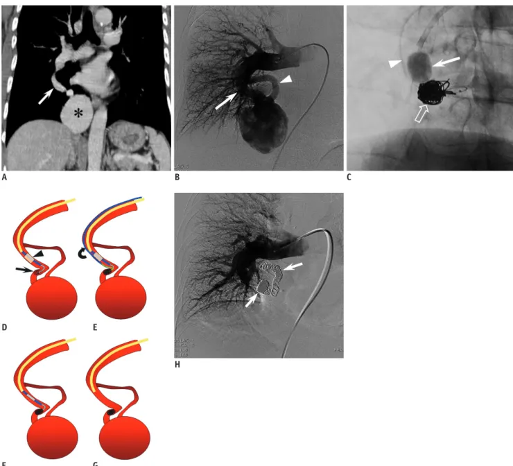 Fig. 1. 50-year-old man with giant, complex-type pulmonary arteriovenous malformation in right thorax.