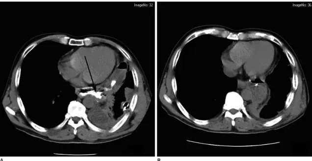 Fig. 1. Intrathoracic anastomotic leak testified by CT at 1 week postoperation. 