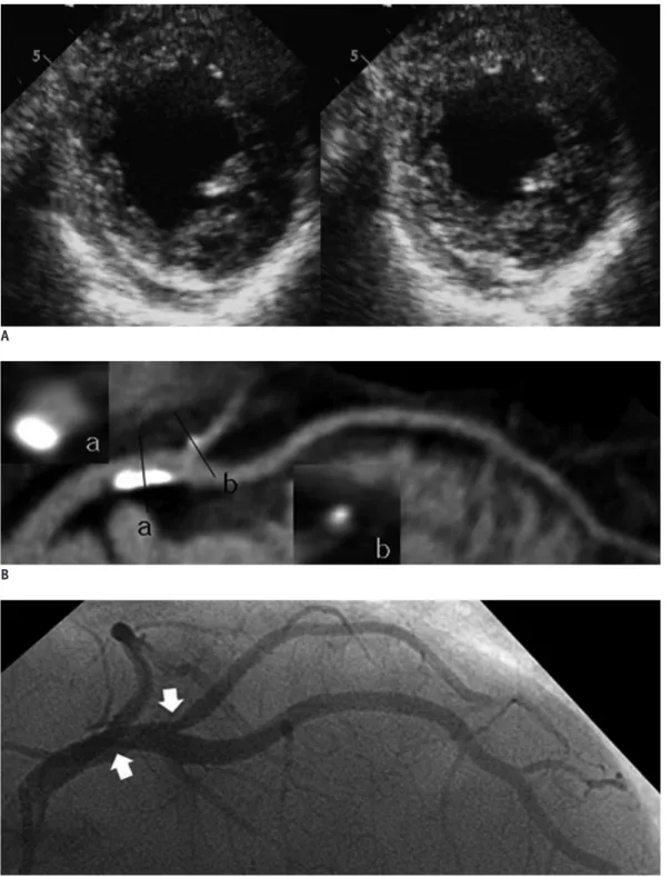 Fig. 1. Isolated non-compaction of left ventricle in 72 year-old-male with new-onset heart failure