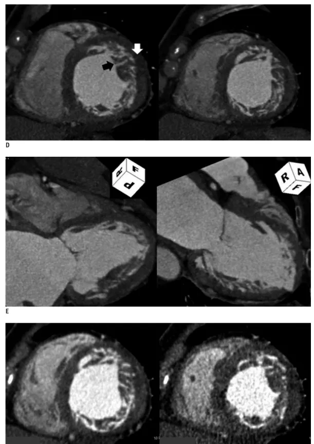 Fig. 1. Isolated non-compaction of left ventricle in 72 year-old-male with new-onset heart failure
