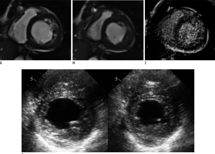 Fig. 1. Isolated non-compaction of left ventricle in 72 year-old-male with new-onset heart failure.