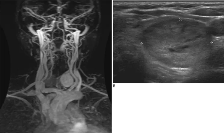 Fig. 1. 58-year-old man with left thyroid nodule, subsequently diagnosed as benign by US-guided FNAB.