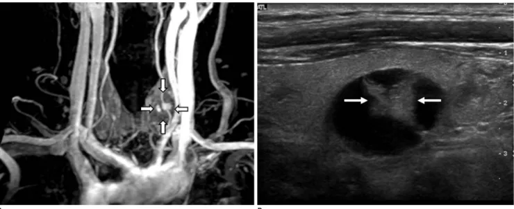 Fig. 2. 60-year-old man with left thyroid nodule, subsequently diagnosed as benign by US-guided FNAB.
