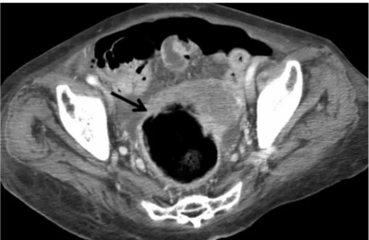 Table 2. Diagnostic Values of Individual CT Signs for Fatal SC