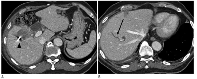 Fig. 2. Fiducial migration.