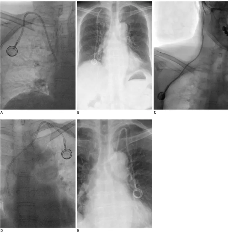 Fig. 2. Case of catheter migration. 