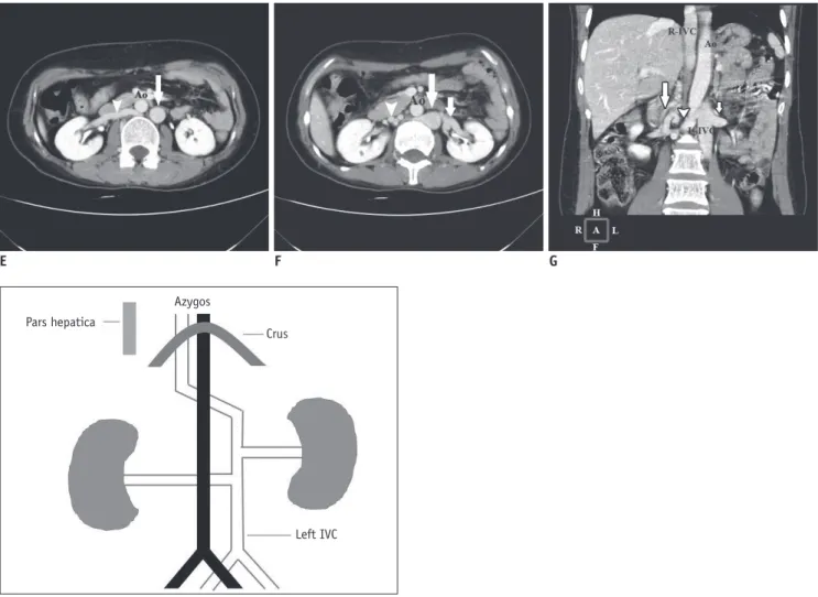 Fig. 1. Complicated malformation of left inferior vena cava presenting as nutcracker syndrome in 42-year-old woman.