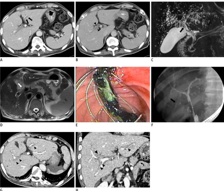 Fig. 1. 68-year-old man with biliary cast formation with sclerosing cholangitis in critically ill patients.