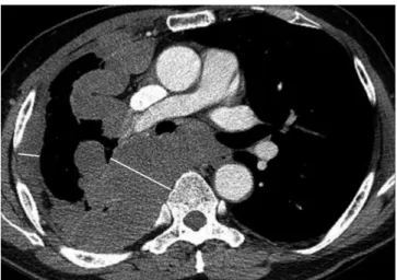 Fig. 9. Malignant pleural mesothelioma of epithelioid subtype in 57-year-old man.