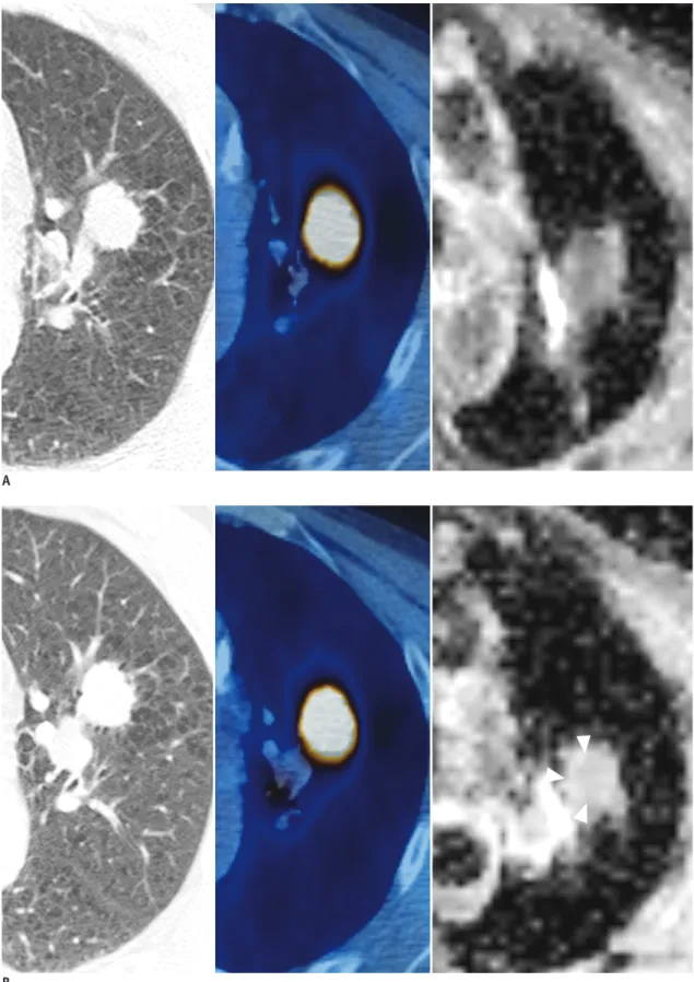 Fig. 11. Patient with non-small cell lung cancer.
