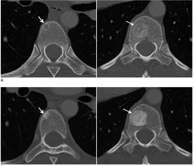 Fig. 6. Patient with breast cancer and bone metastasis.