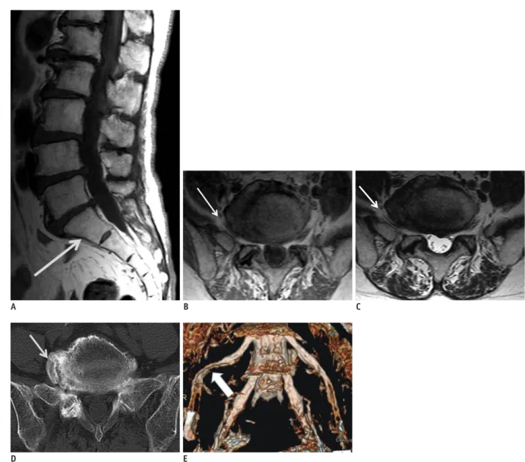 Fig. 3. 64-year-old woman presenting with indentation of right L5 nerve root in symptomatic extraforaminal stenosis with  lumbosacral transitional vertebra.