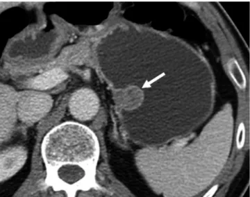Fig. 1. Gastrointestinal stromal tumors in gastric upper body  of 57-year-old man.  Transverse CT scan shows well-defined, round  mass with heterogeneously moderate enhancement (arrow) in gastric  upper body