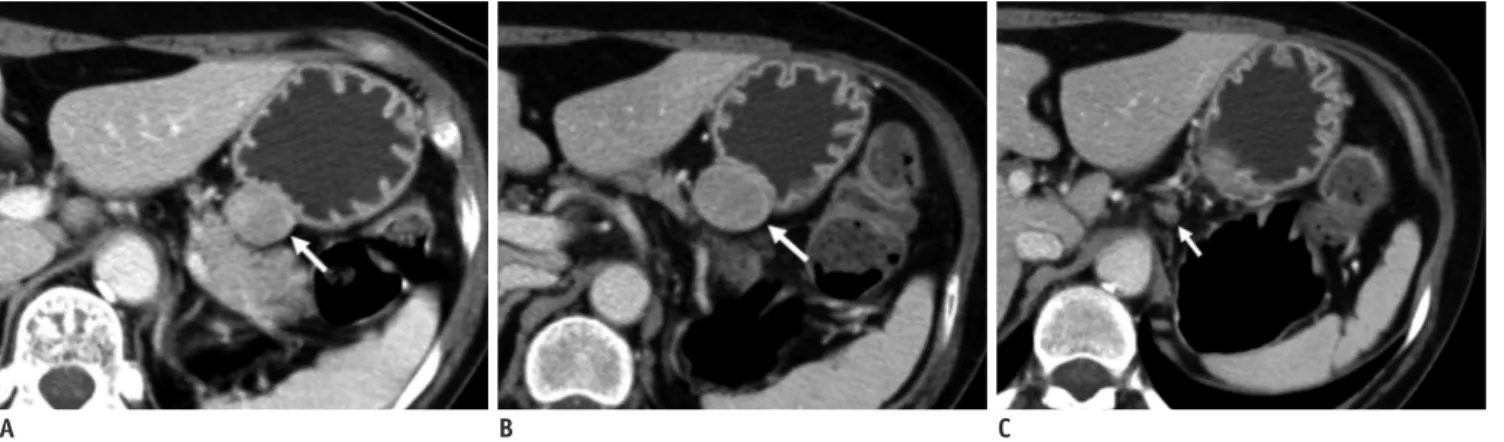 Fig. 6. Gastric schwannomas in gastric upper body of 65-year-old woman.