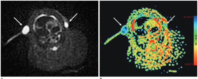 Fig. 3. Manifestation of diffusion-weighted imaging and apparent diffusion coefficient map of axillary metastatic lymph nodes.