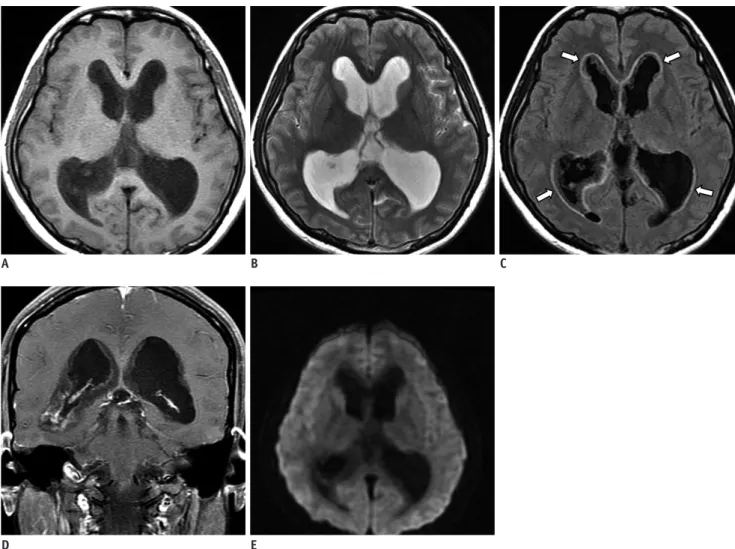 Fig. 1. Diffuse ependymal dysembryoplastic neuroepithelial tumor with spinal drop metastasis in 29-year-old female patient.