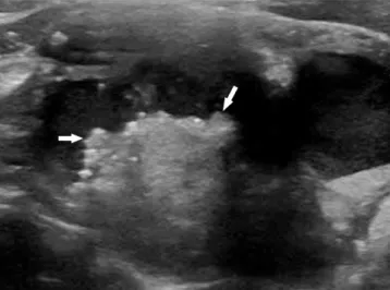 Fig. 5. Transverse ultrasound image of predominantly cystic  nodule in 63-year-old woman shows eccentric configuration of  internal solid portion with multiple microcalcifications