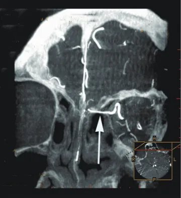 Fig. 2. Same patient with Fig. 1.  Coronal maximum intensity  projection image of three-dimensional spin digital subtraction  angiography well depicts intra-ethmoidal course of anterior ethmoid  artery (arrow).
