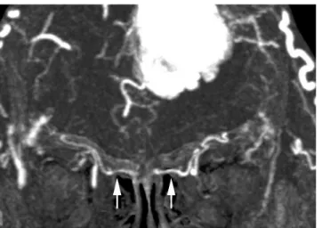 Fig. 6. Axial multiplanar reformations image shows bony  notch (arrowhead) on medial wall of orbits, corresponding to  anterior ethmoidal foramen.