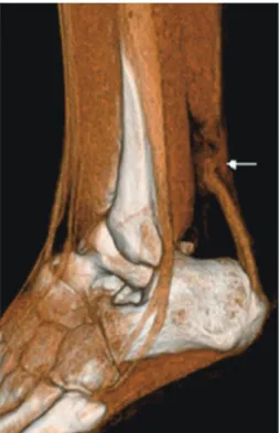 Fig. 7. Compression of tendon.  Oblique sagittal MPR of gemstone  spectral imaging found mass located in proximal phalanx bottom  of little finger