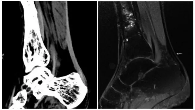 Fig. 8. Fiftysix year old male patient experienced slight claudication for fifteen years but no pain after surgery for fracture of left  lower leg.
