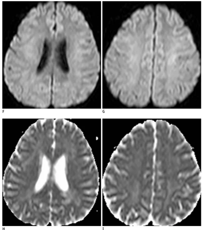 Fig. 1. Brain MRI in 36-year-old man with right facial palsy and motor weakness.