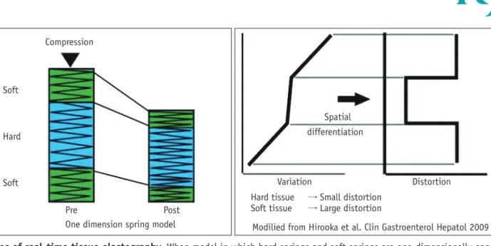 Fig. 1. Principles of real-time tissue elastography.  When model in which hard springs and soft springs are one-dimensionally connected  is compressed, hard springs are negligibly deformed, but soft springs are markedly deformed