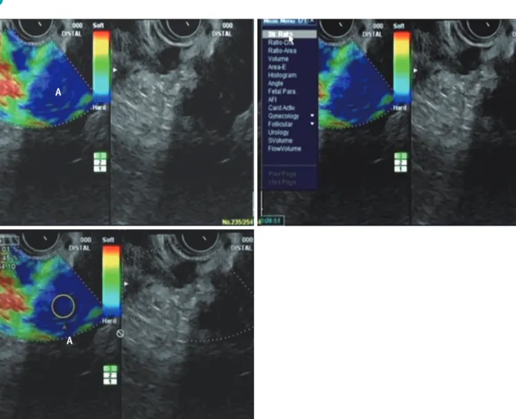 Fig. 2. Quantitative analysis of pancreatic cancer using EUS elastography.  
