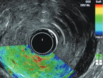 Fig. 4. EUS elastography of pancreatic cancer.  Elastographic imaging of pancreatic cancer is characterized by heterogeneous blue color  distribution (representing hard stiffness).