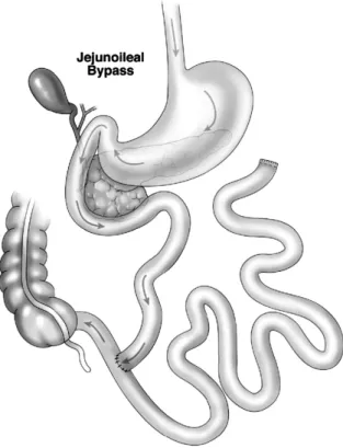 Fig.  1.  Jejunoileal  bypass.