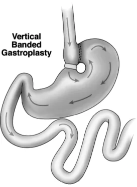 Fig.  3.  Gastric  bypass.