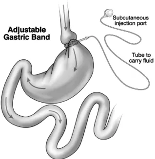 Fig.  4.  Adjustable  gastric  banding.