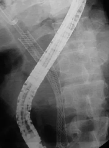 Fig. 3. Method to provide subsegmental drainage when fully  covered stent was inserted in benign biliary stricture near  hepatic hilum