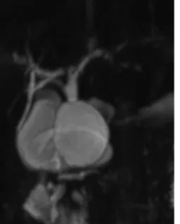 Fig. 2. Magnetic resonance cholangiopancreatography image of  type Ic choledochal cyst.