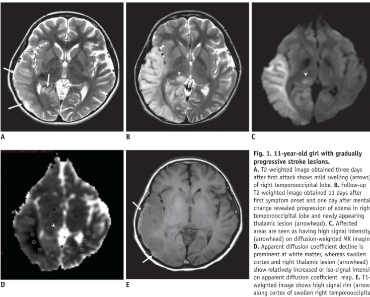 Fig. 1. 11-year-old girl with gradually  progressive stroke lesions.