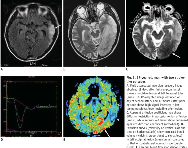 Fig. 3. 57-year-old man with two stroke- stroke-like episodes.