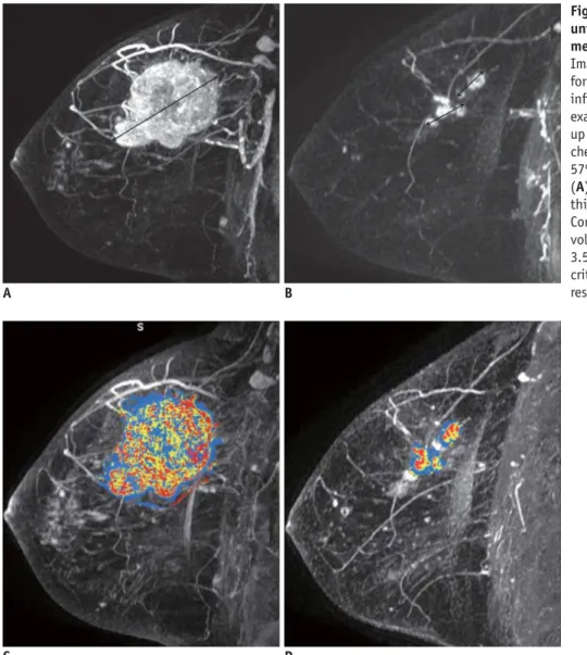 Fig. 2. Concordant case between  unidimensional and three dimensional  measurements is presented